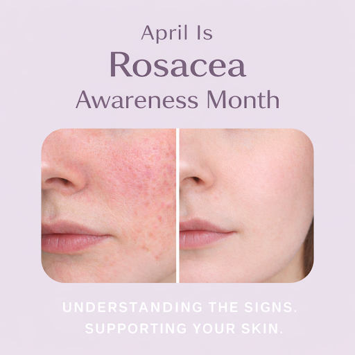 April Is Rosacea Awareness Month